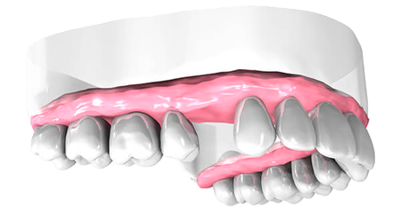 Examen pré-implantaire - Cabinet dentaire Dr Oget-Evin - Dentiste Châlons-en-Champagne