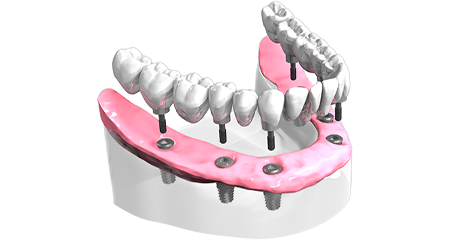 Implantologie dentaire - Cabinet dentaire Dr Oget-Evin - Dentiste Châlons-en-Champagne