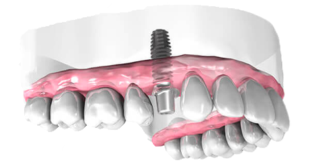 Implant dentaire - Cabinet dentaire Dr Oget-Evin - Dentiste Châlons-en-Champagne