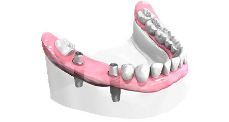 Bridge dentaire - Cabinet dentaire Dr Oget-Evin - Dentiste Châlons-en-Champagne