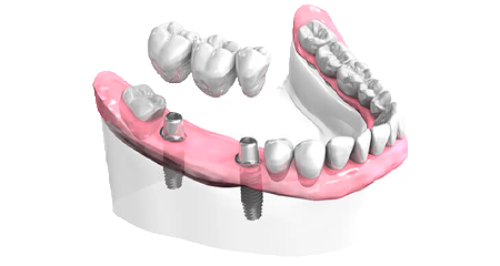 Bridge dentaire - Cabinet dentaire Dr Oget-Evin - Dentiste Châlons-en-Champagne