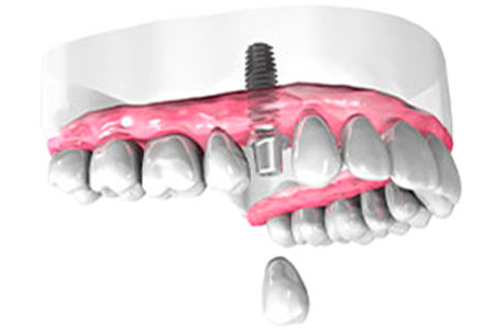 Implant dentaire - Cabinet dentaire Dr Oget-Evin - Dentiste Châlons-en-Champagne