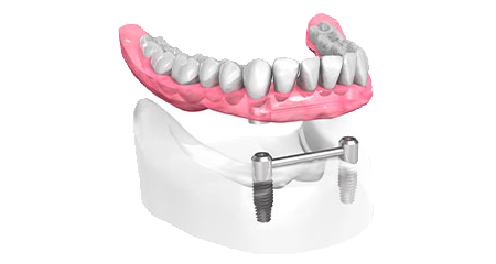 Prothèse dentaire - Cabinet dentaire Dr Oget-Evin - Dentiste Châlons-en-Champagne