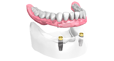 Prothèse dentaire - Cabinet dentaire Dr Oget-Evin - Dentiste Châlons-en-Champagne