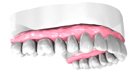 Remplacement de dents - Cabinet dentaire Dr Oget-Evin - Dentiste Châlons-en-Champagne